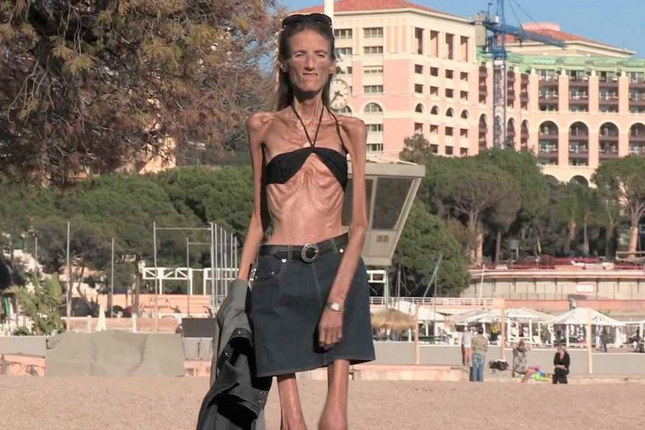 Судьба самой худой женщины планеты. Иммигрантка хотела соответствовать