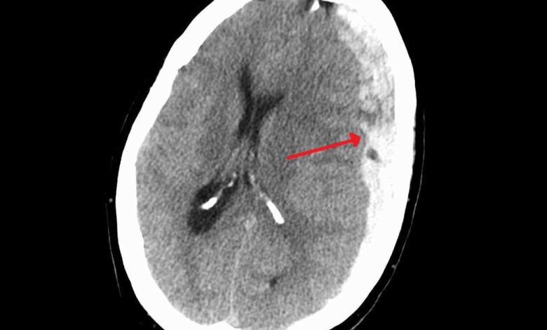 Digital Tool Developed in Russia to Predict Recovery After Severe Head Injuries