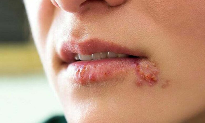 Spanish Scientists Uncover Unexpected Effect of Valacyclovir in Alzheimer’s