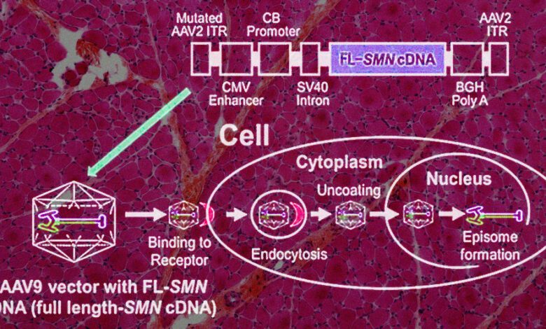 Интратекальная генная терапия открыла новые возможности для лечения СМА у детей и подростков