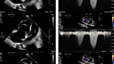 В Швейцарии у женщины с анорексией выявили редкую форму легочной гипертензии