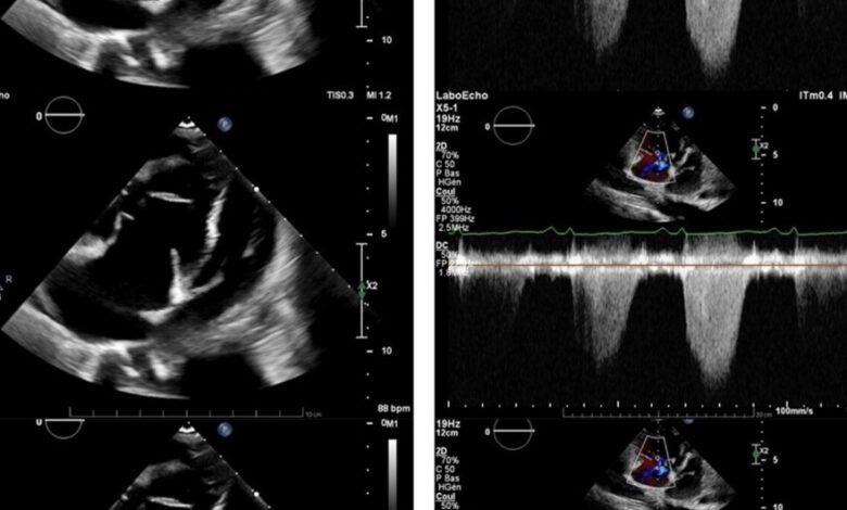 В Швейцарии у женщины с анорексией выявили редкую форму легочной гипертензии