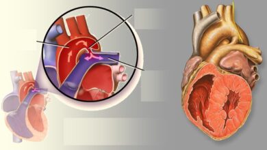 Выжидательная стратегия при открытом артериальном протоке у недоношенных детей снижает смертность