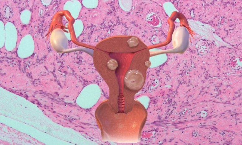 Long-Term Link Between Uterine Fibroids and Cardiovascular Disease Risk Identified