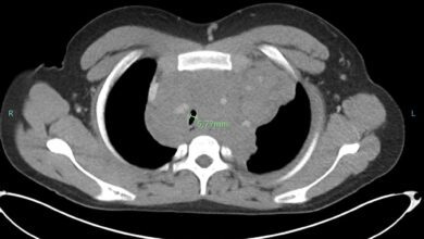 Врачи провели уникальную биопсию средостения у подростка под гипнозом в Канаде