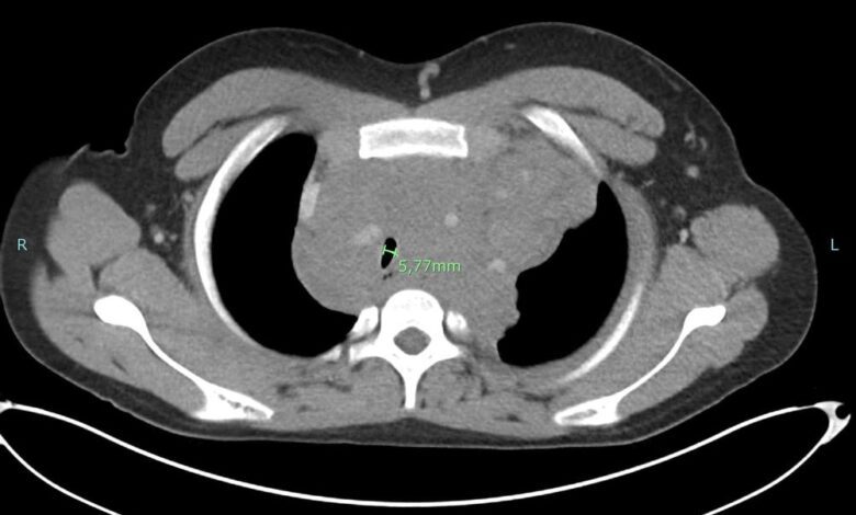 Canadian Doctors Perform Unique Mediastinal Biopsy on Teenager Under Hypnosis