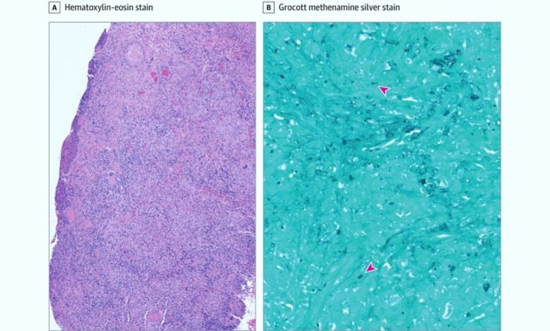 Rare Fungal Infection Presents Unusual Symptoms in Elderly US Patient
