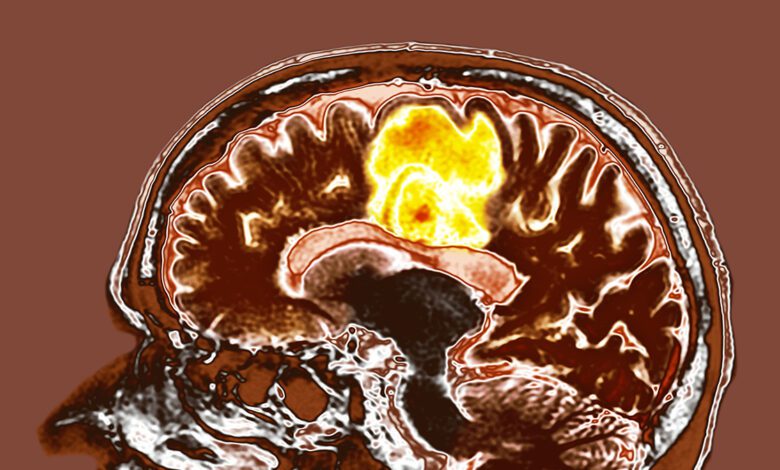 Two Popular Nutraceuticals Show Potential in Fighting Glioblastoma