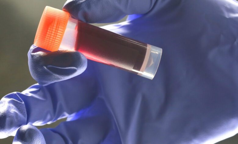 Scientists Find Link Between Blood Type and Stroke Risk Before Age 60