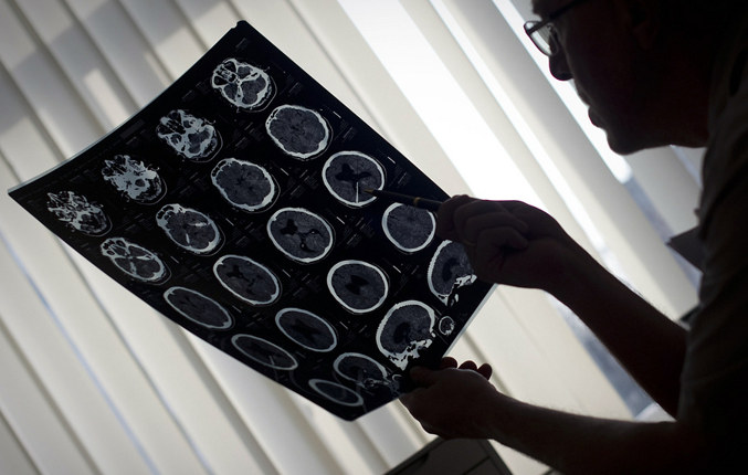 Ученые из России, Испании и США: нейропротектор нового поколения