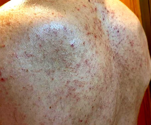 Испанская наука: Появилась сыпь как при ветрянке или крапивнице? Covid-19!