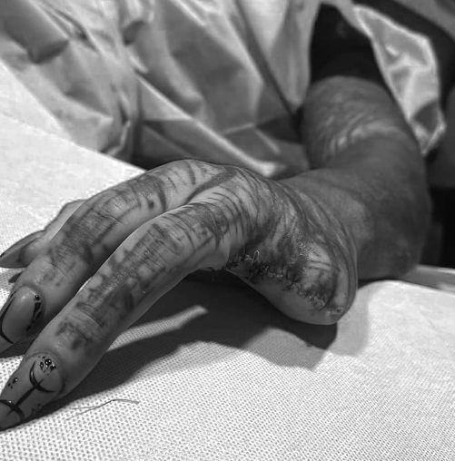 Марка (Испания). «Черный инопланетянин» хочет ампутировать себе ногу после удаления пальцев, ушей, носа. «Полная дегуманизация»