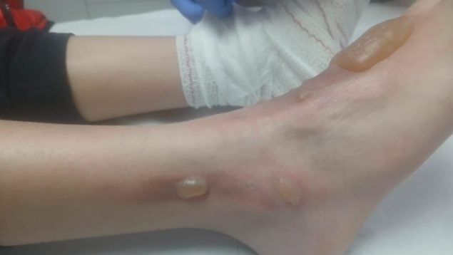 12-year-old boy in Cadiz tortured a classmate with a heated knife